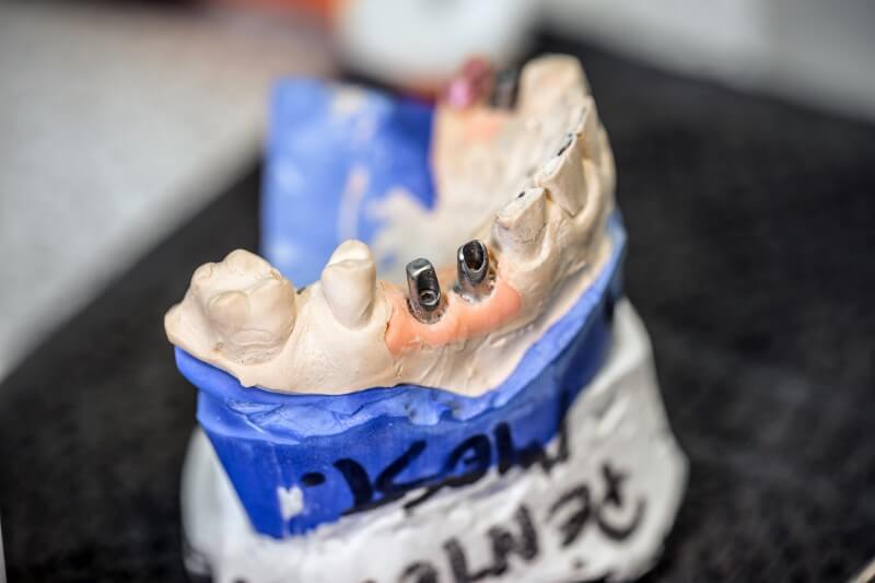 dental-implants-PCUTWRZ (1)
